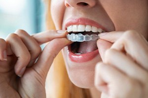 Close up of patient inserting an Invisalign tray