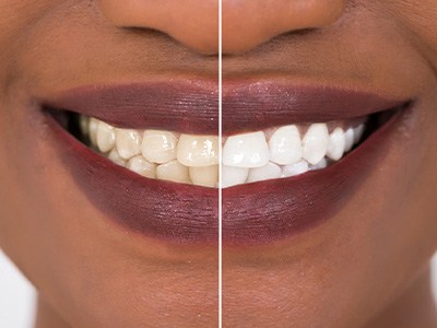 Patient's smile before and after teeth whitening