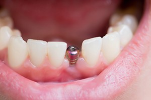 patient smiling with implant in mouth 