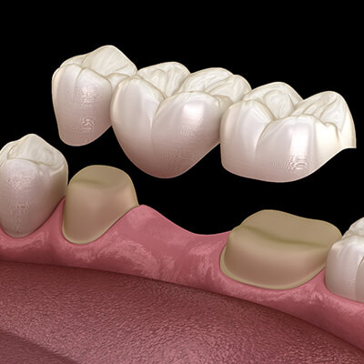 a computer illustration of a dental bridge in Fort Worth being used  to replace a missing tooth