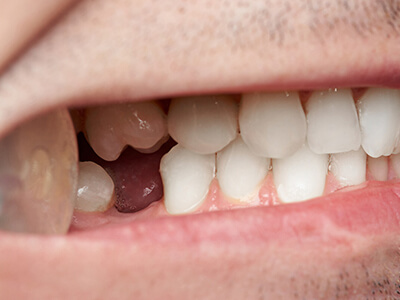 Close up of person with a missing tooth