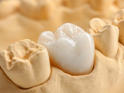 Model of the mouth with a dental crown over one tooth
