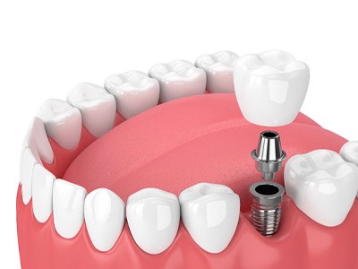 Illustrated dental implant being placed in the lower jaw