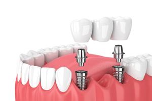 Two dental implant posts supporting a dental bridge
