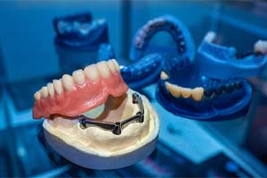 Model of implant dentures in Fort Worth