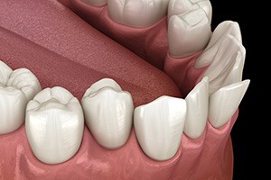 Illustration of crooked teeth