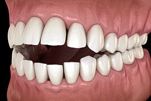 Illustration of an open bite