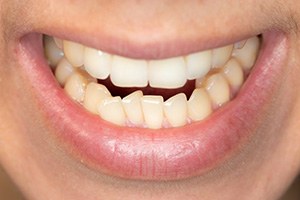 Closeup of patient with crowded teeth before Invisalign