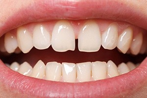 Closeup of patient with a space between their two front teeth before Invisalign