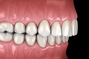 Digital illustration of an overbite before Invisalign