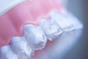 Digital illustration of an overbite before Invisalign