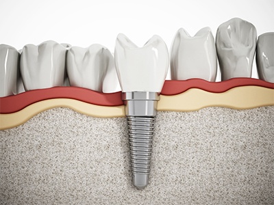 Illustration of dental implant within the lower jaw