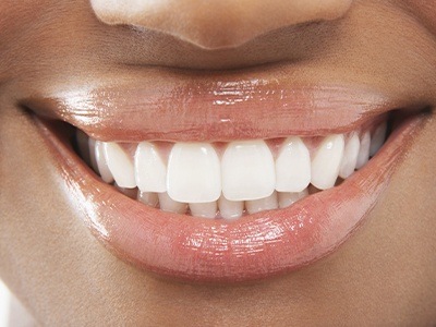 Close up of smile with flawless teeth