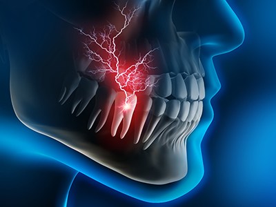 Illustrated side profile of head with red pain lines coming from tooth