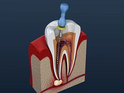 Illustrated dental instrument cleaning inside of tooth