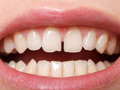An up-close image of a person’s top and bottom teeth and the small gap between their two upper front teeth