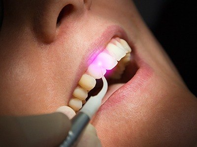 Dentist using soft tissue laser to treat gums