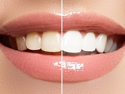 Close up of smile before and after teeth whitening