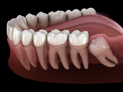 Illustration of wisdom tooth growing in sideways