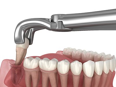 Illustration of a tooth being extracted