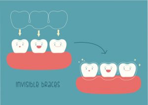 How to of invisible braces by tooth concept Illustrator