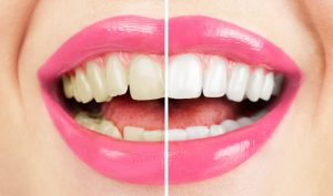 Custom whitening trays fit comfortably and snugly over teeth.