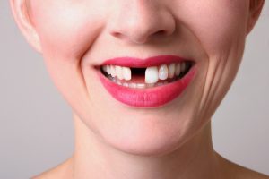 Dental implants can fix missing teeth for good.