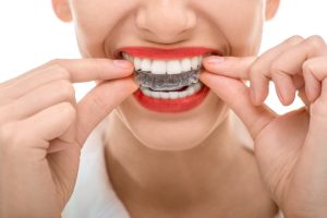 Here are the top questions to ask your dentist about Invisalign in 76123.