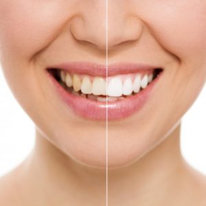 before and after results of teeth whitening