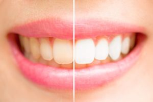 teeth-whitening-crazy-solutions