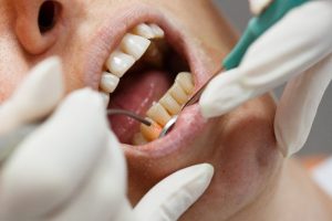 Man enjoying the benefits of gum recontouring