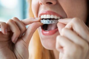 Woman fitting Invisalign aligner on to teeth. 