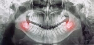 X-ray showing impacted wisdom teeth.